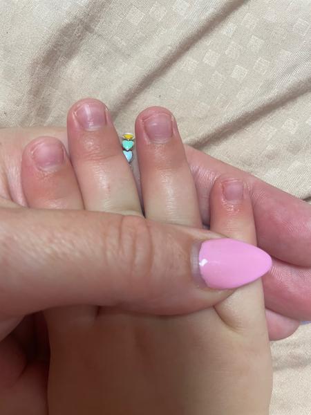 Oddelenie nechtu od kožičky, bodky na nechtoch