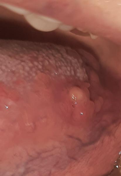 Nebojte sa vriedku na jazyku: Čo robiť?