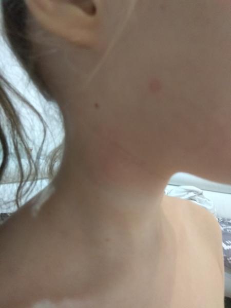 Vyrážky? Čo to môže byť?