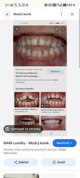 Otvorený zhryz u detí kvôli cumlíku