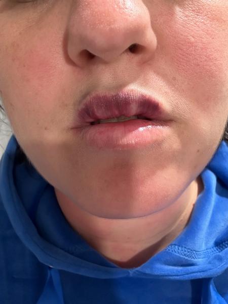 Modriny po vyplní pier kyselinou