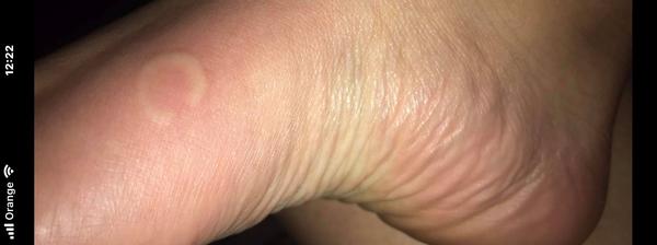 Aké červené fľaky sa mi vyhadzujú na chodidlách a na dlaniach?