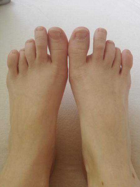 Je možné skrátenie prstov na nohe?
