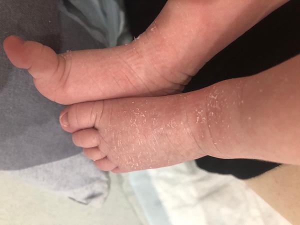 Je v poriadku, že sa novorodenecká pokožka šúpe?