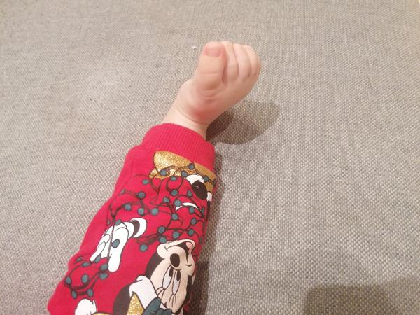 10-mesačné dieťa nesedí a má inak nôžku