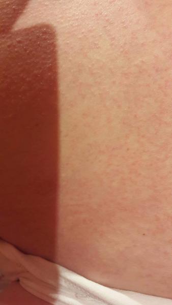 Môže to byť alergia na lieky?