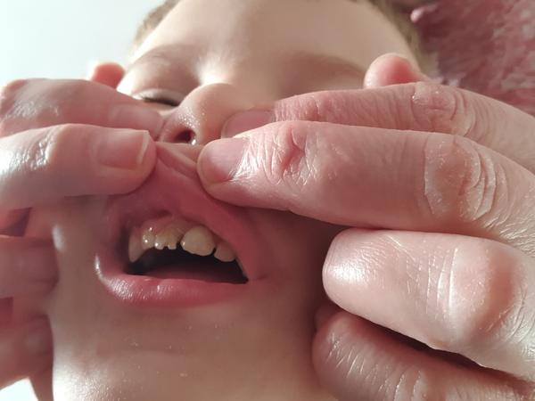 Vačok s hnisom u štvorročného syna. Čo nám odporúčate?