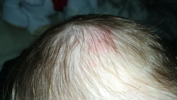 5-mesačný syn si buchol hlavu, mám ísť na pohotovosť?