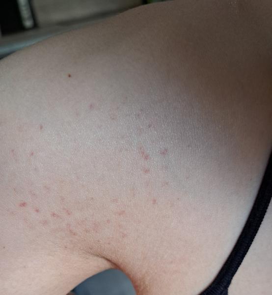 Čo spôsobil vyrážku na mojom ramene?