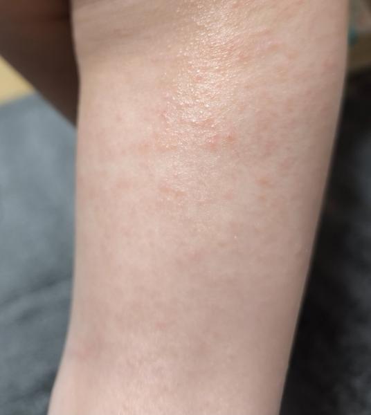 Je to ekzém alebo vírusová reakcia?