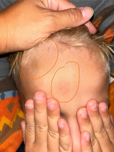 Modrina na synovom čele: Rady a skúsenosti