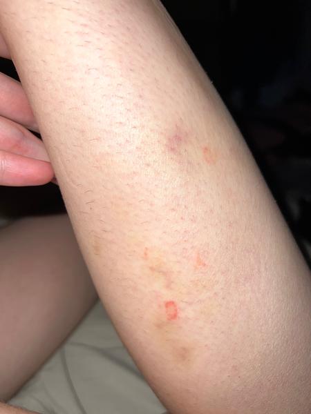 Aká škvrna sa mi urobila na ruke?