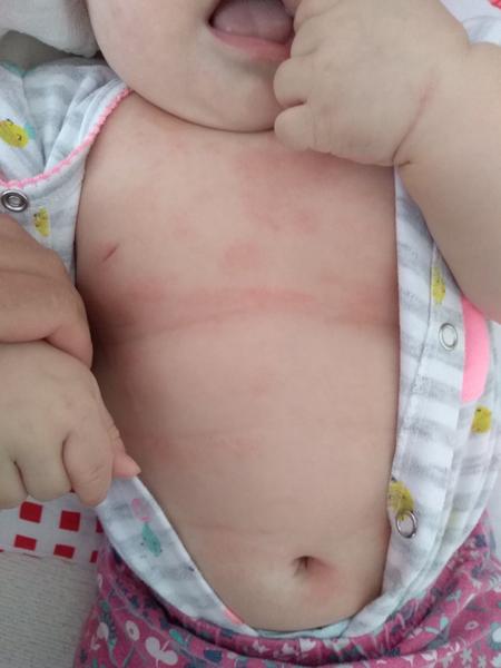 Môže byť toto ekzém?