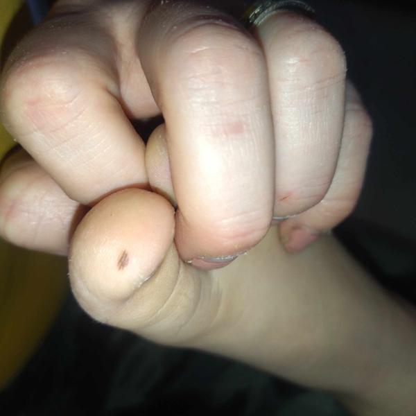 Znepokojené pozorovanie znamienka na palci u dcérky?