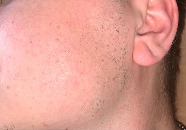 Je to naozaj rosacea? Skúsenosti a rady.