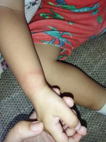 Z čoho môže byť tento štípanec?