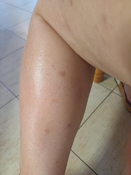 Čo môžu znamenať fľaky na nohách?