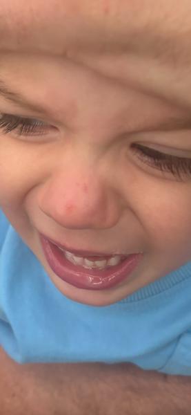 Čo spôsobilo vyrážky na nose u dieťaťa?