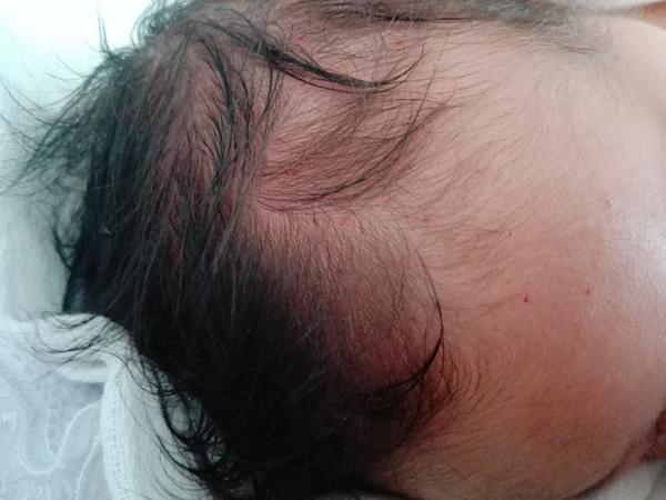 Červené bodky na hlavičke mesačného bábätka