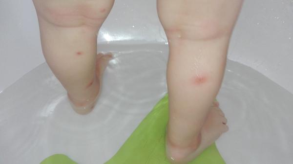 Vyrážky u dieťaťa