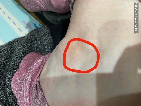 Akú hrčku mám na členku?