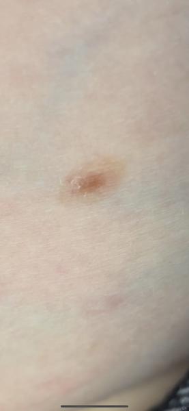 Potrebujem navštíviť kožnú kvôli znamienku?
