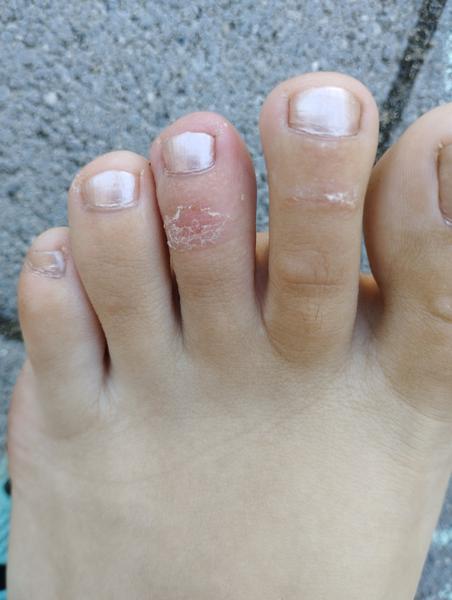 Suché miesta na nohách