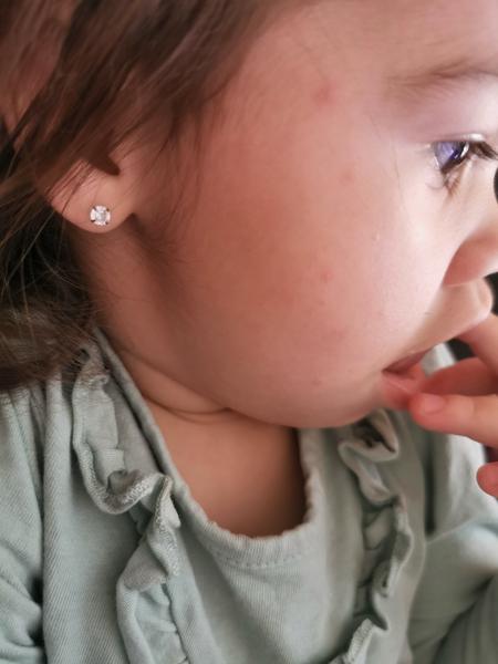 Môže mať dieťa vyrážky na tváričke zo zubov?