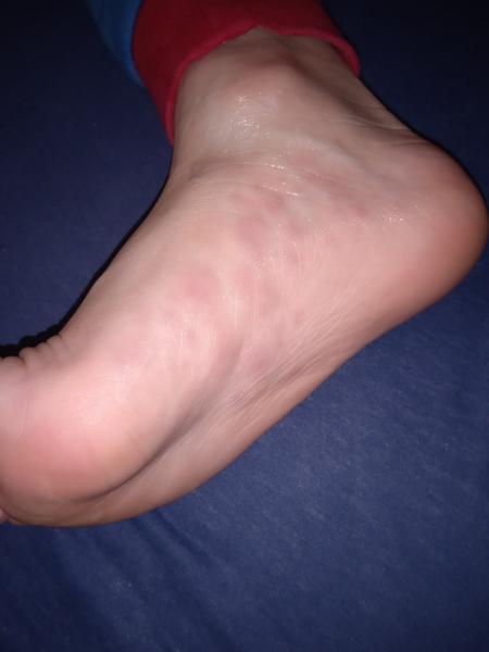 Fľaky na chodidle a bolesť kĺbov u detí: Rady a skúsenosti