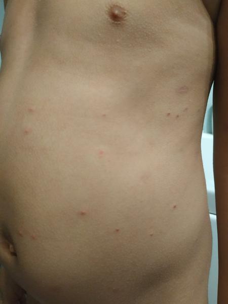 Aké vyrážky to má môj syn na tele?