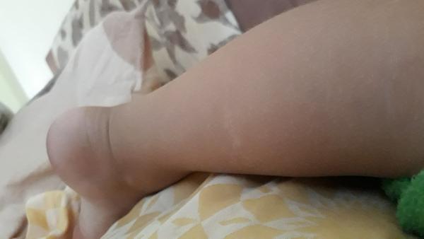 Ako liečiť znamienka, v ktorých chýba pigment?