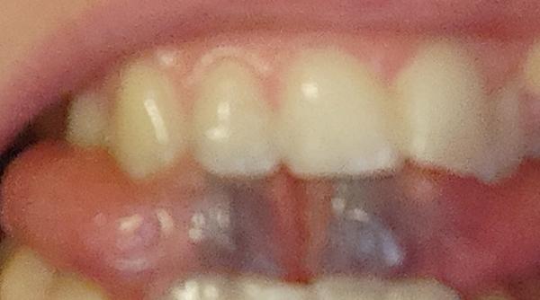 Čo znamenajú fialové čiary pod jazykom?