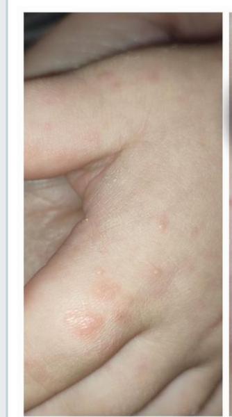 Vyražky na zadku a chrbte ruky u detí.