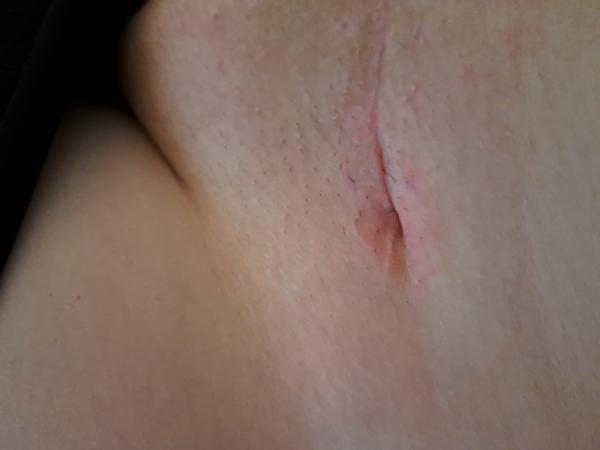 Je priehlbina po sekcii bežná skúsenosť?