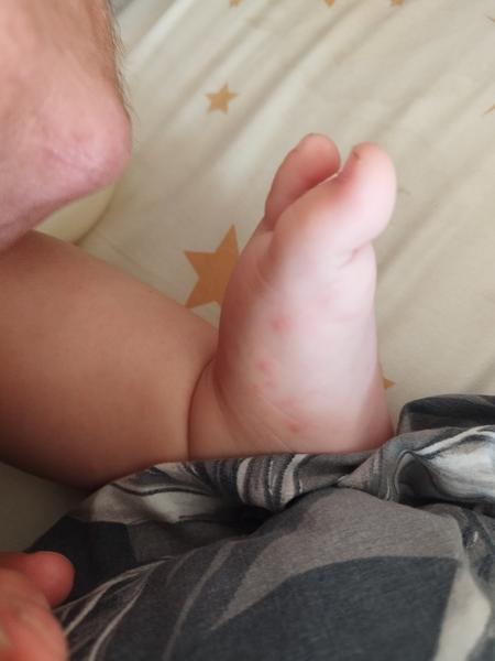 Sú to osýpky alebo kiahne?