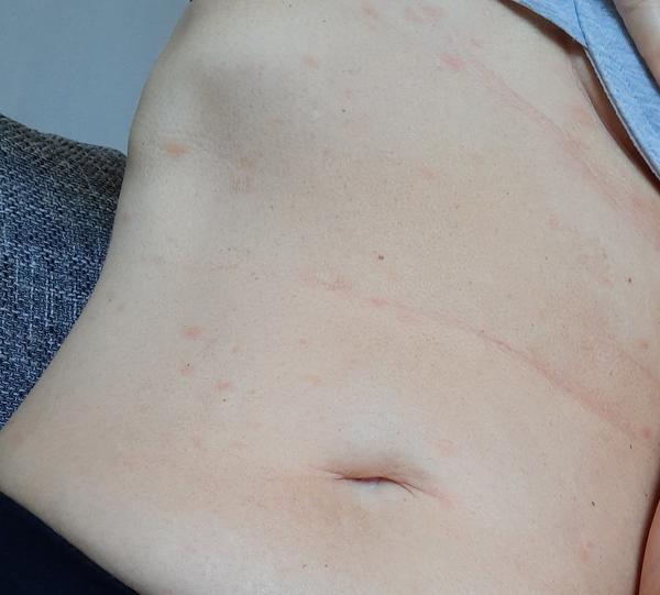 Aké vyrážky mám po tele?