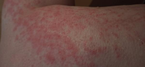 Ako zmierniť alergiu na Sorbifer Durules v 30. týždni tehotenstva?