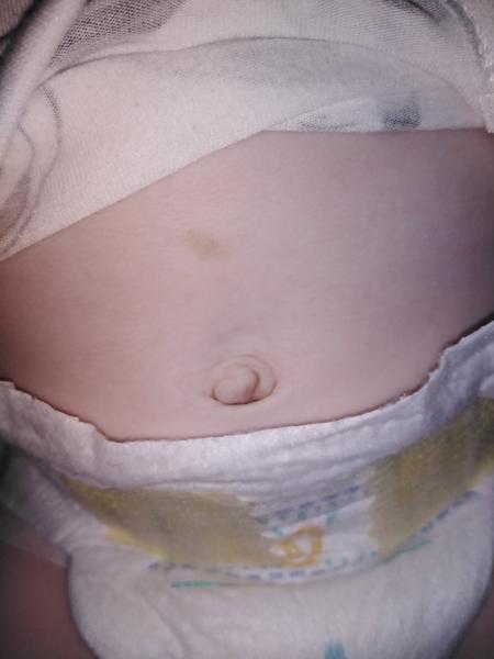 Svetlohnedé fľaky na tele trojmesačného bábätka