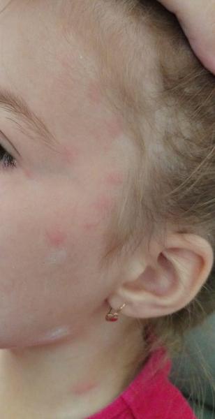 Môže mať očkované dieťa slabý priebeh kiahní?