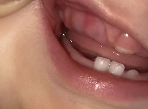 Čierny zúbok pod ďasnom 7 mesačného dieťatka