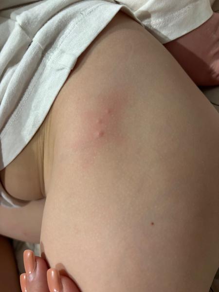 Z coho mozu byt tieto vyrazky,pupence?