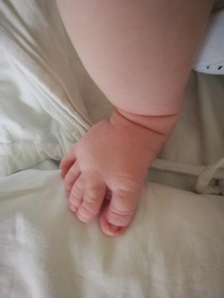 Dajú sa oddeliť spojené prsty na nohách?