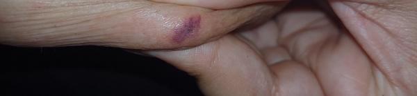 Prečo sa mi tvorí modrastá vyrážka na prsníku?