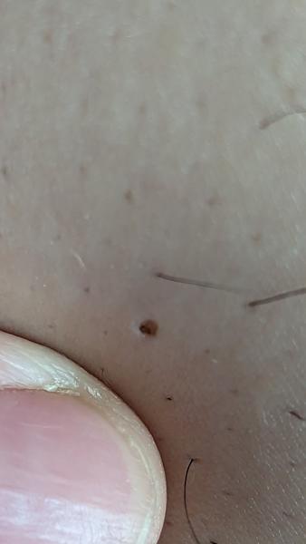 Nebolestivá dierka v koži