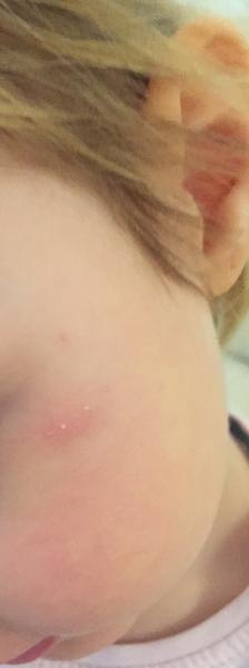 Kedy dcérke zmizne fľak po úraze?