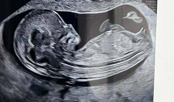 Ako určiť pohlavie bábätka v 12. týždni?