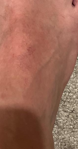 Svrbenie na bicepsoch