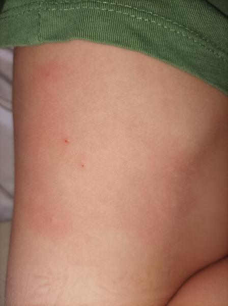 Štípance - vyrážky