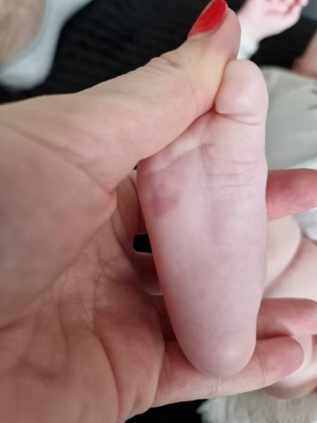 Fľak na chodidle u 2-mesačnej dcérky