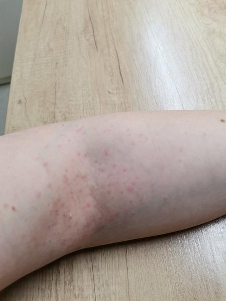 Z čoho mám toto na rukách?